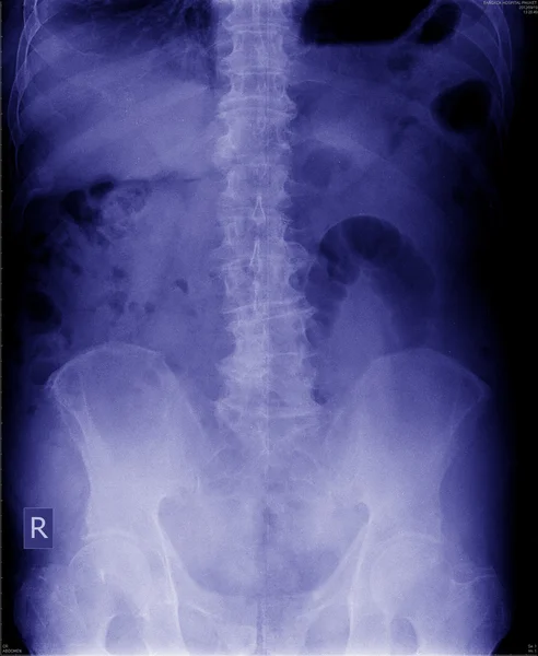 X-ray a has — Stock Fotó