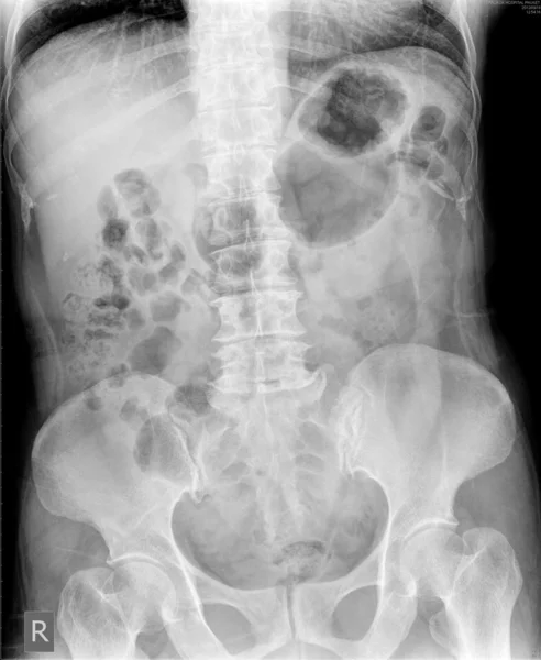 Röntgenfoto van de buik — Stockfoto