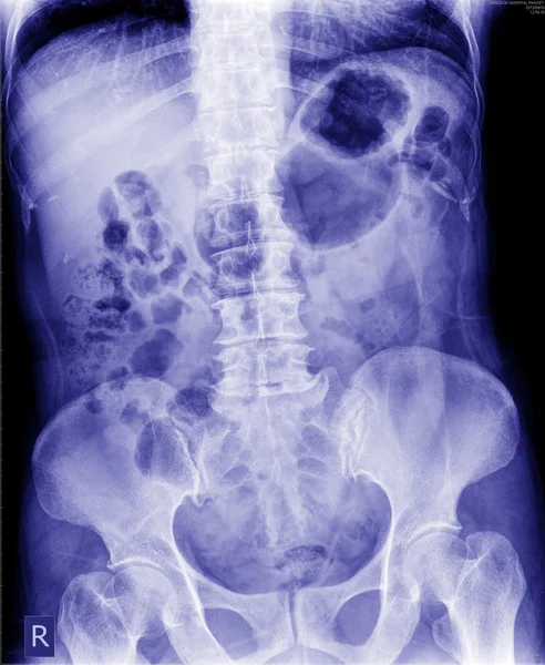 Röntgenkuva vatsan — kuvapankkivalokuva