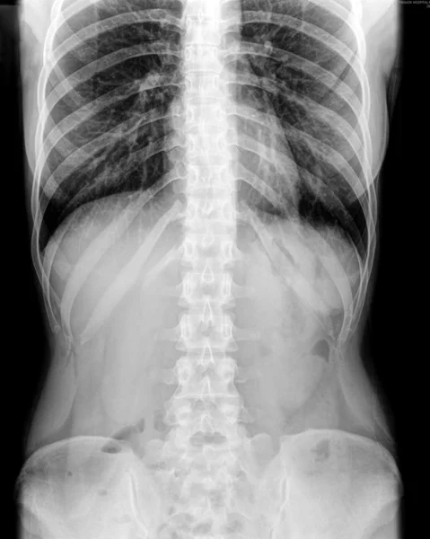 X-ray of the abdomen — Stock Photo, Image