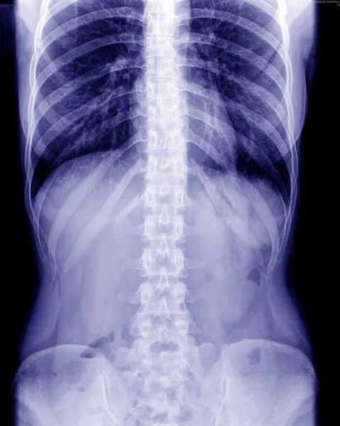 X-ray a has — Stock Fotó