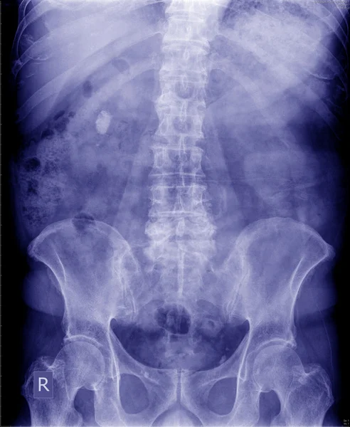 X-ray of the abdomen — Stock Photo, Image