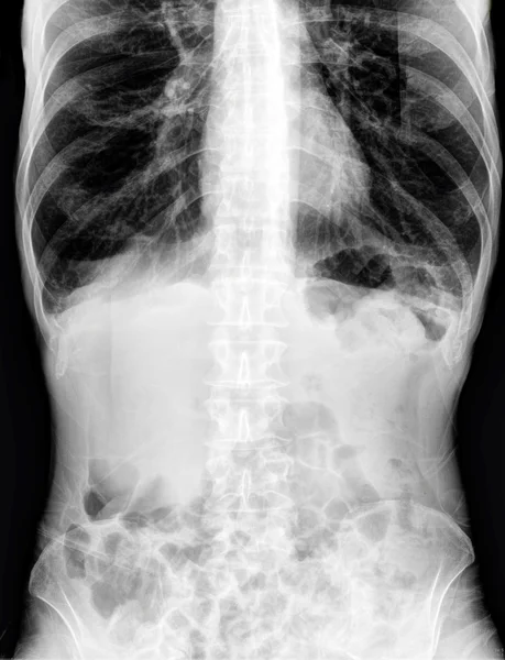 X-ray of the abdomen — Stock Photo, Image