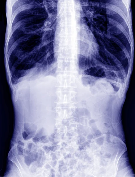 X-ray of the abdomen — Stock Photo, Image