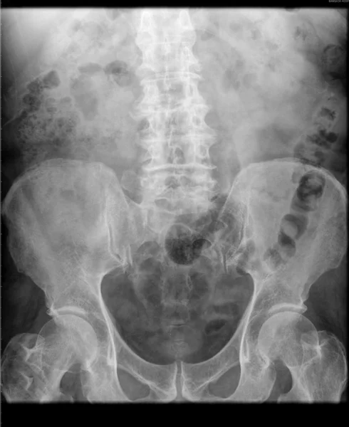 X-ray of the abdomen — Stock Photo, Image