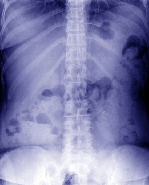 Radiographie de l'abdomen — Photo