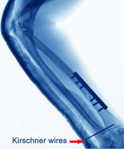 A csont törések x ray — Stock Fotó