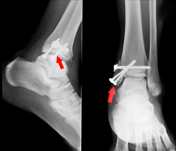 X ray of fractures bone — Stock Photo, Image