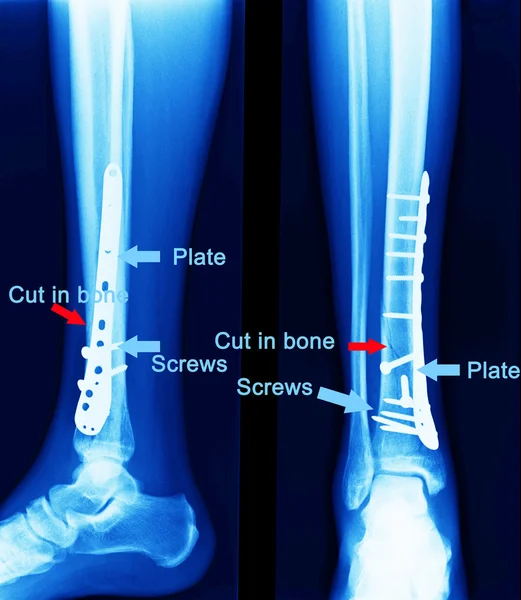 X ray of fractures bone — Stock Photo, Image