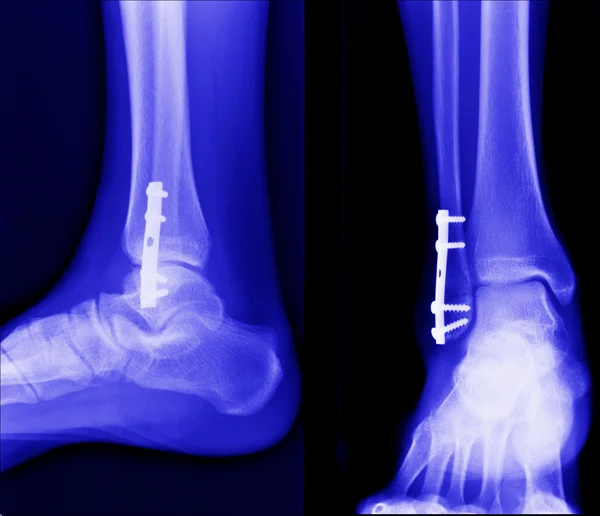 X ray of fractures bone — Stock Photo, Image