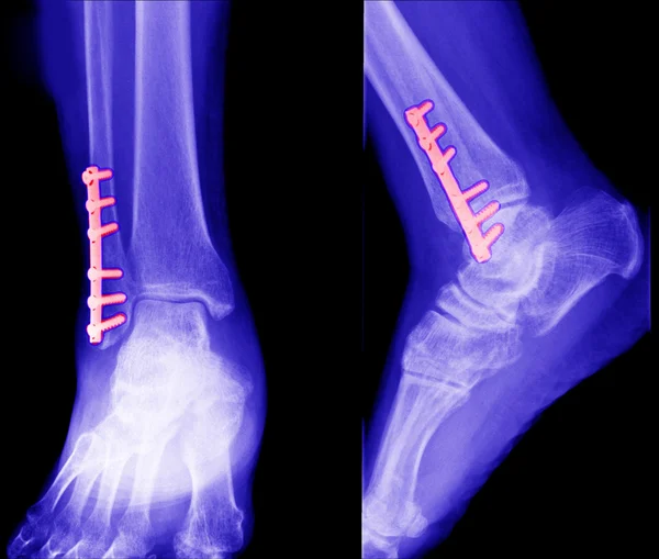 X ray of fractures bone — Stock Photo, Image