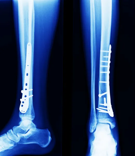 X ray of fractures bone — Stock Photo, Image