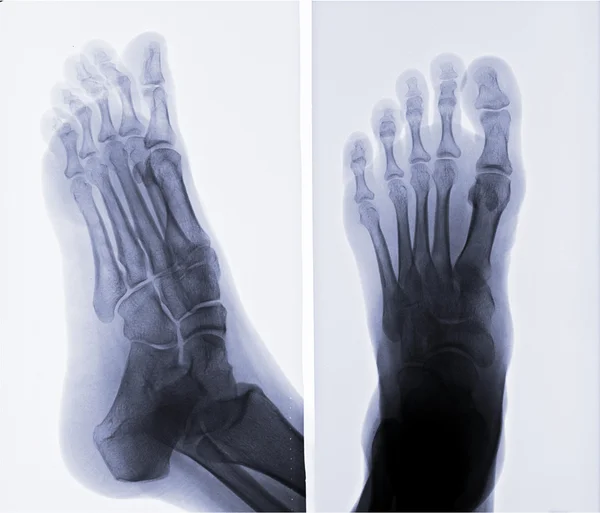 X-ray picture of foot — Stock Photo, Image