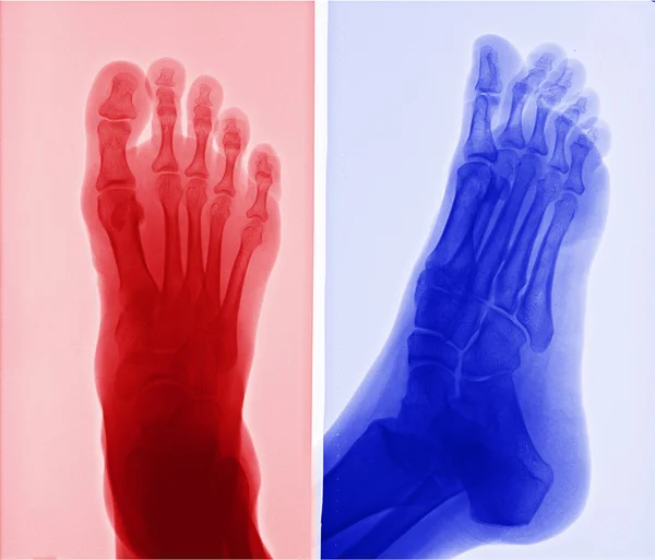 Immagine a raggi X del piede — Foto Stock