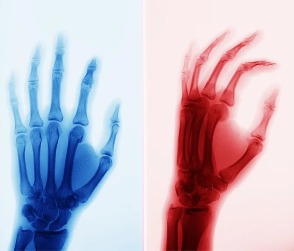 X-ray foto van hand — Stockfoto