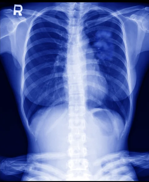 X ray van longkanker bij vrouwen — Stockfoto