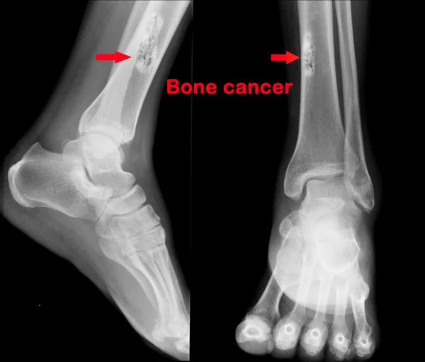 骨肿瘤 x 射线 — 图库照片