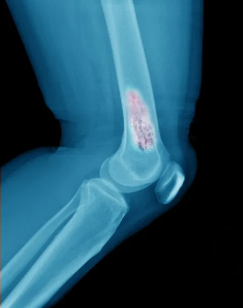 X ray of Bone cancer — Stock Photo, Image