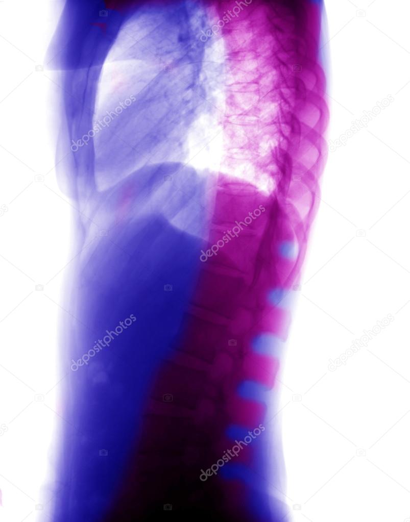 X-ray picture of lumbar vertebrae