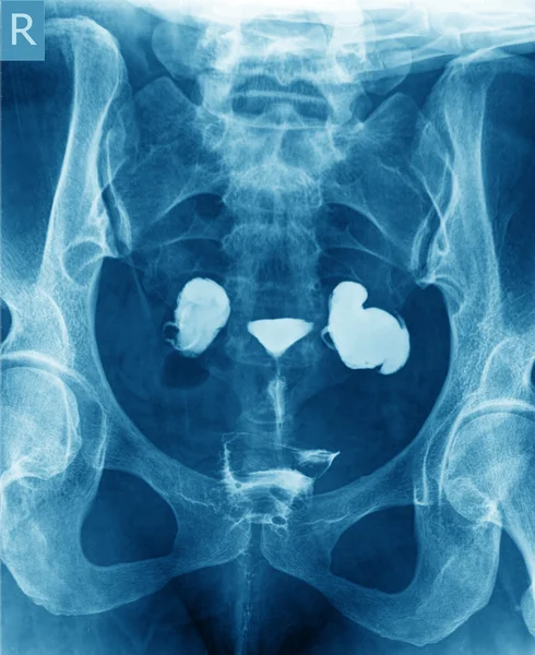 Röntgenbild der Gebärmutter — Stockfoto