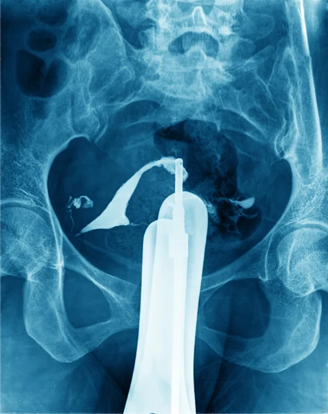 X ray of Uterus — Stock Photo, Image