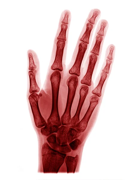 X-ray picture of hand — Stock Photo, Image