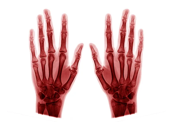 X-ray foto van hand — Stockfoto