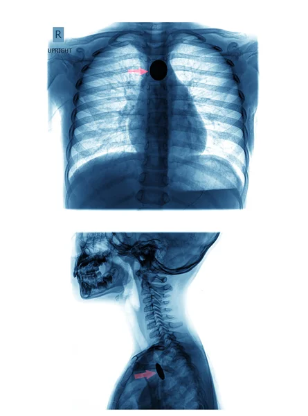 X-ray images of coin in esophagus — Stock Photo, Image