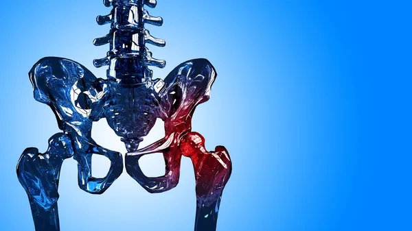 Squelette section douleur de hanche — Photo