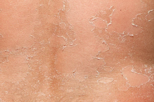 Part of peeling back — Stock Photo, Image