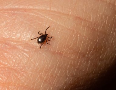 Bulaşıcı Ensefalit Ixodes Scapularis veya Persulcatus Geyik Tik Böceği Derisi. Ensefalit Virüsü veya Lyme Borreliosis Hastalığı Enfekte Ixodes Araknid Parazit Isırığı Macro.
