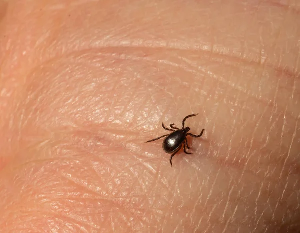 Infektiöse Enzephalitis Ixodes Scapularis Oder Persulcatus Hirschzeckeninsekt Auf Der Haut — Stockfoto