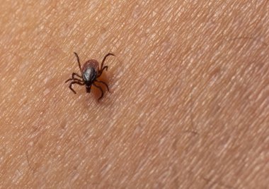 Enfekte olmuş dişi geyik, kıllı insan derisinde kene taşıyor. Ixodes ricinus. Parazit mayt. Acarus. Üst deri detaylarının arka planında tehlikeli ısırgan böcekler var. İğrenç bir enfeksiyon taşıyıcısı. Kene kaynaklı hastalıklar.