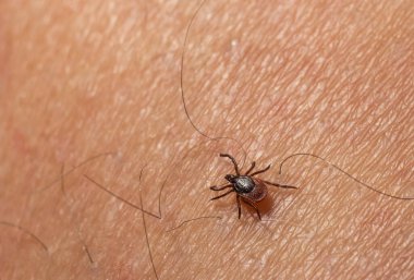 The parasite mite sits on a persons skin. infection carrier. Ixodes ricinus.