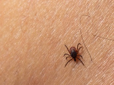 Enfekte olmuş dişi geyik, kıllı insan derisinde kene taşıyor. Ixodes ricinus. Parazit mayt. Acarus. Üst deri detaylarının arka planında tehlikeli ısırgan böcekler var. İğrenç bir enfeksiyon taşıyıcısı. Kene kaynaklı hastalıklar.