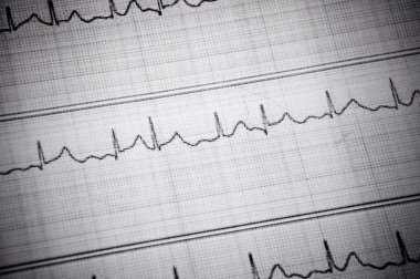 EKG işareti