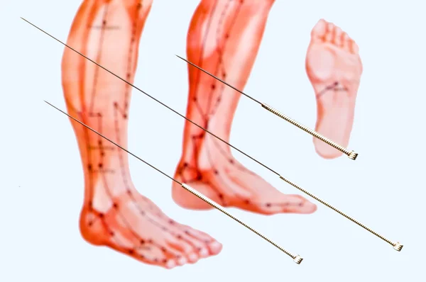 Igła do akupunktury — Zdjęcie stockowe