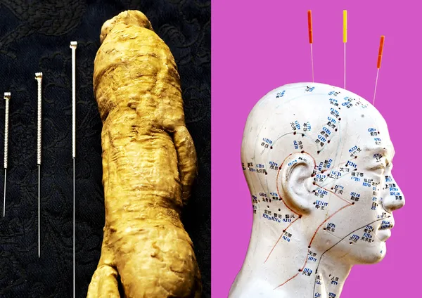 Agulhas de acupuntura, raiz de ginseng e modelo de cabeça — Fotografia de Stock