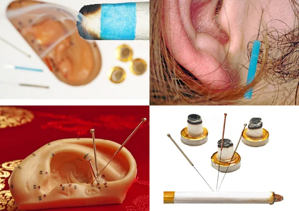 Ear acupuncture — Stock Photo, Image