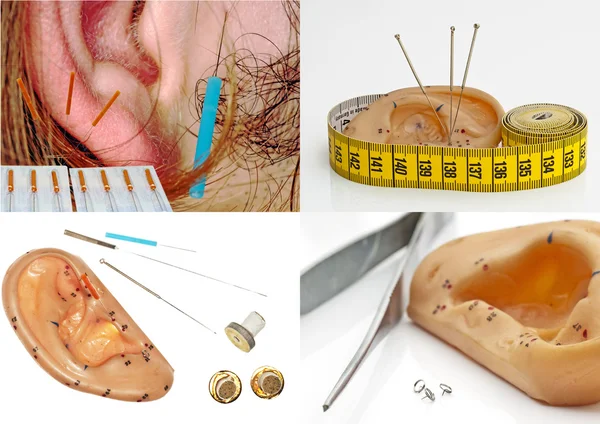 Ear acupuncture — Stock Photo, Image