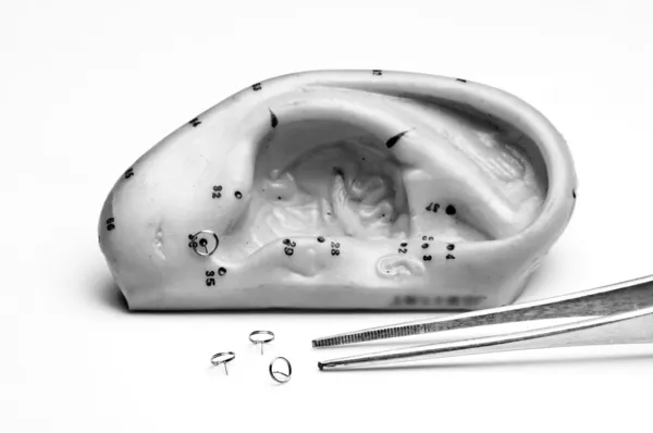 Akupunkturnadeln und Ohrmodell — Stockfoto