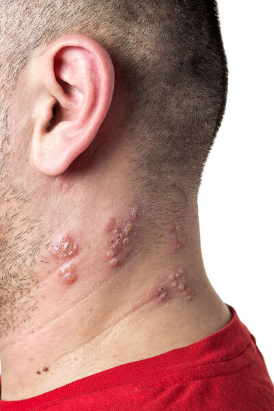 shingles virus