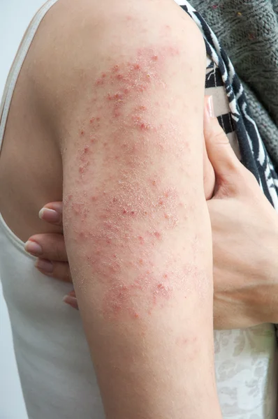 Allergische uitslag dermatitis — Stockfoto