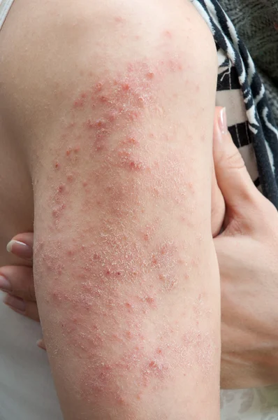 Alergická vyrážka dermatitida — Stock fotografie