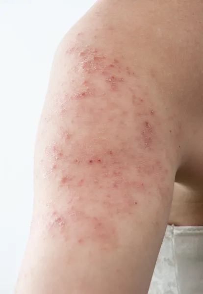 Allergische uitslag dermatitis — Stockfoto