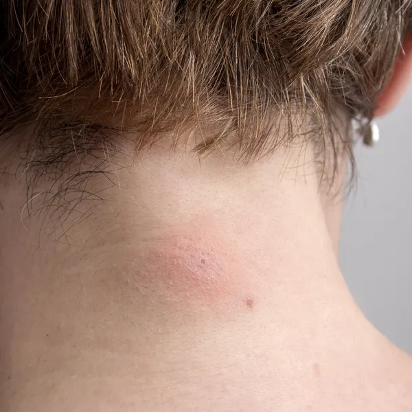 Insect bite on Caucasian skin — Stock Photo, Image
