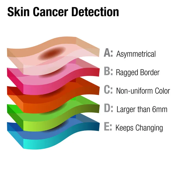 Detección de cáncer de piel — Vector de stock