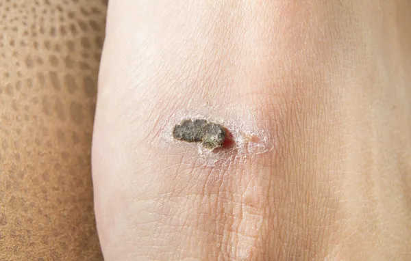 Foot Wound Healing — Stock Photo, Image