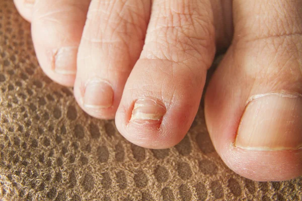 Regrown voet nagel — Stockfoto