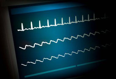 Patient monitor showing vital signs ECG and EKG. 